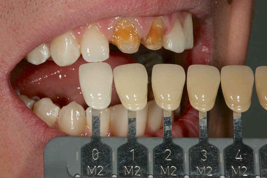 Patient case from Amos Harting, USA. Shade selection.