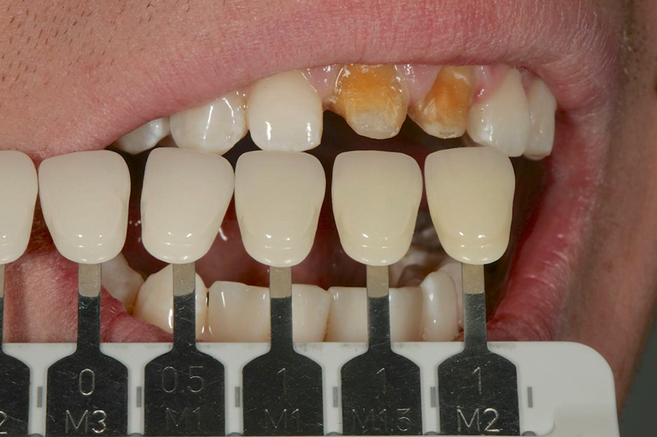 Patient case from Amos Harting, USA. Shade selection.