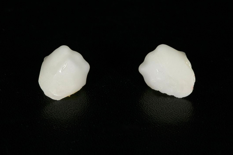 Caso clinico di Amos Harting, USA. Realizzazione delle cappette in biossido di zirconio.