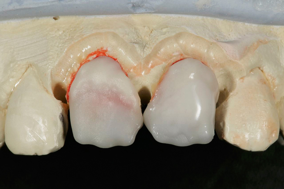 Patient case from Amos Harting, USA. Application of VITA VM 9 CHROMA PLUS.