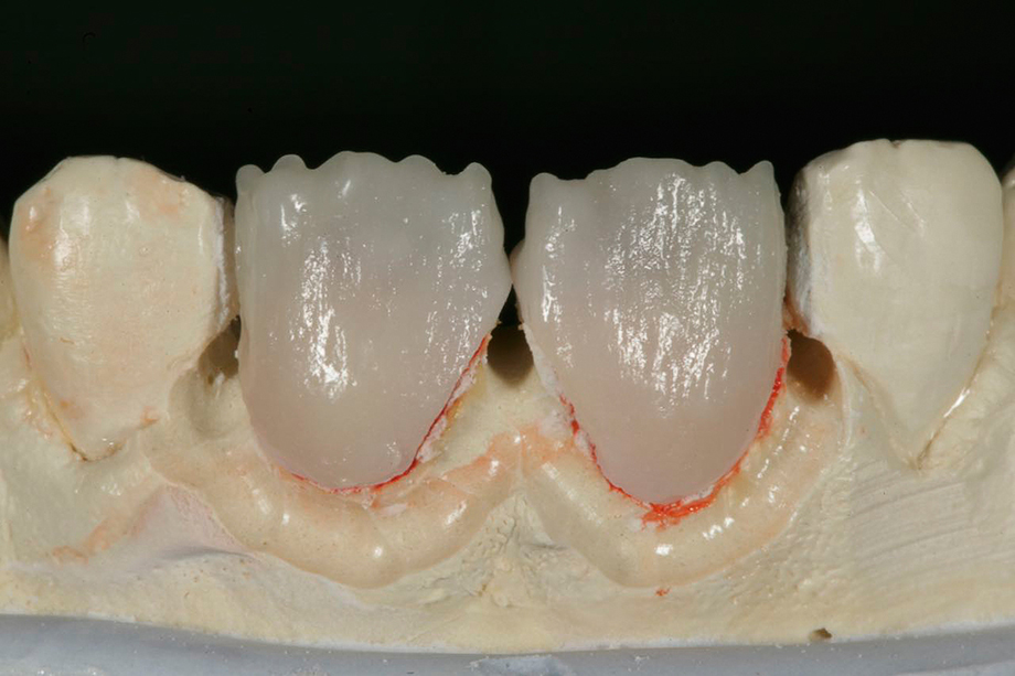 Cas clinique d'Amos Harting, USA. CHROMA PLUS après cuisson.