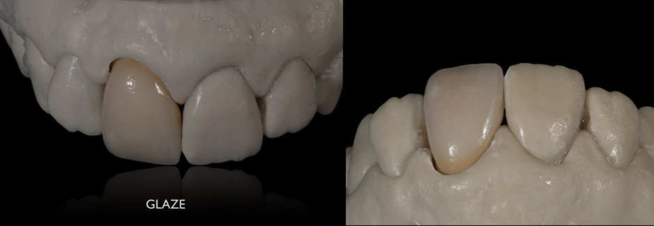 Patient case: Individual anterior crown of VITAPM®9.  Francesco Ferretti. Rome, Italy.