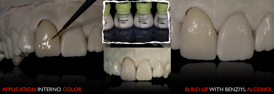 Patient case: Individual anterior crown of VITAPM®9.  Francesco Ferretti. Rome, Italy.