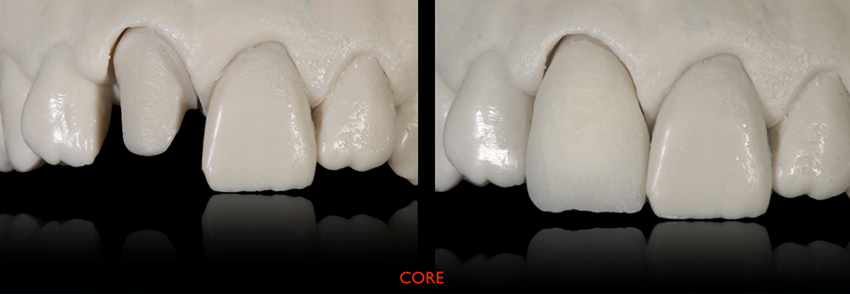 Caso clínico: Corona anterior individual de VITAPM®9