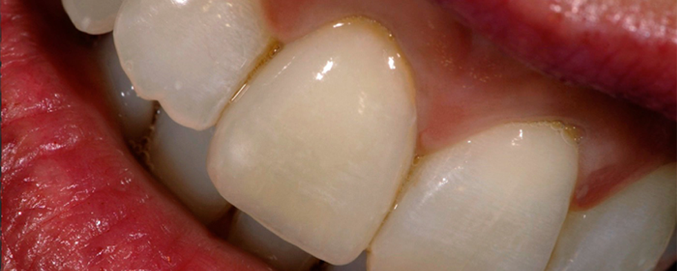 Cas clinique :  Couronne unitaire sur dent antérieure en VITAPM®9. Francesco Ferretti Rome, Italie.