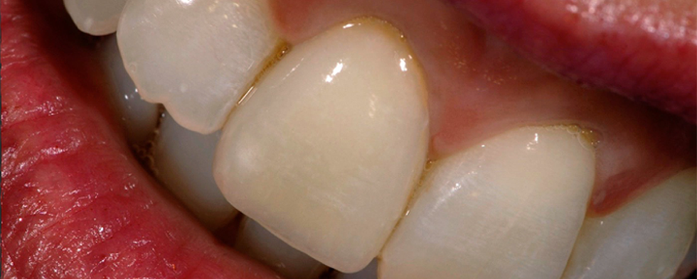 Patient case: Individual anterior crown of VITAPM®9. Francesco Ferretti Rome, Italy.