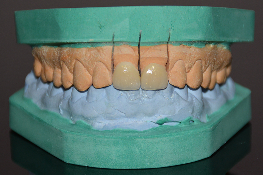 Patient case by Manoj Chhabra and Rohit Rana. GHAZIABAD, India.