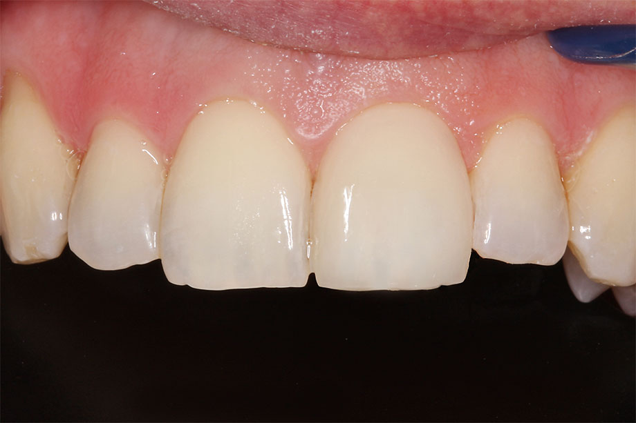 Fig. 10: Resultado final con un efecto cromático natural en la boca del paciente.