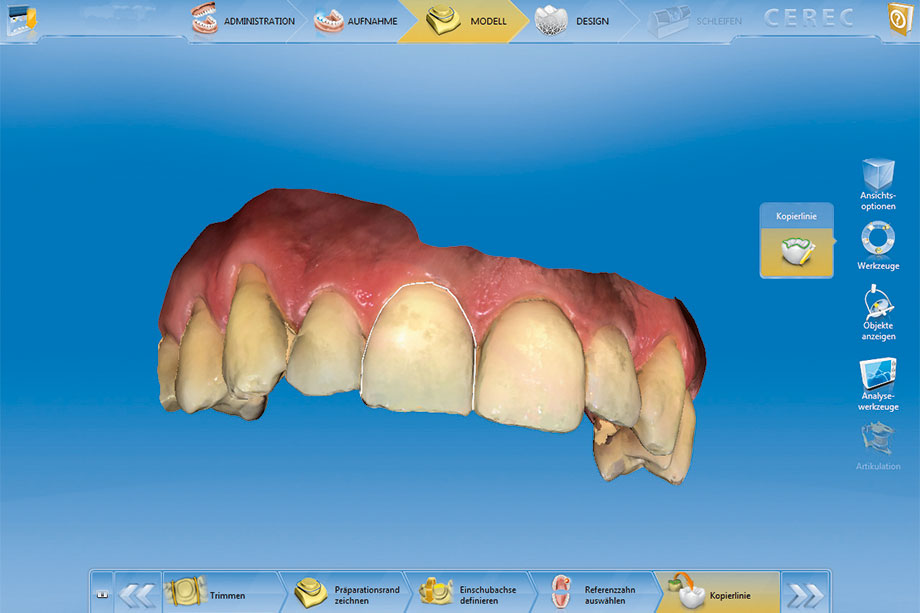 Fig. 5: Reflexión del diente 11.