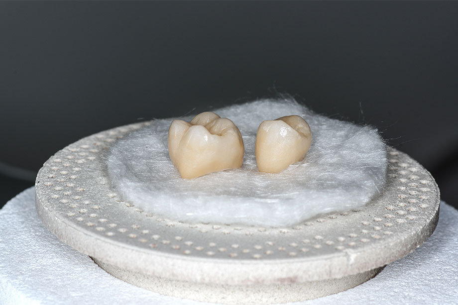 Two crowns fabricated with CAD/CAM support from VITABLOCS Mark II.