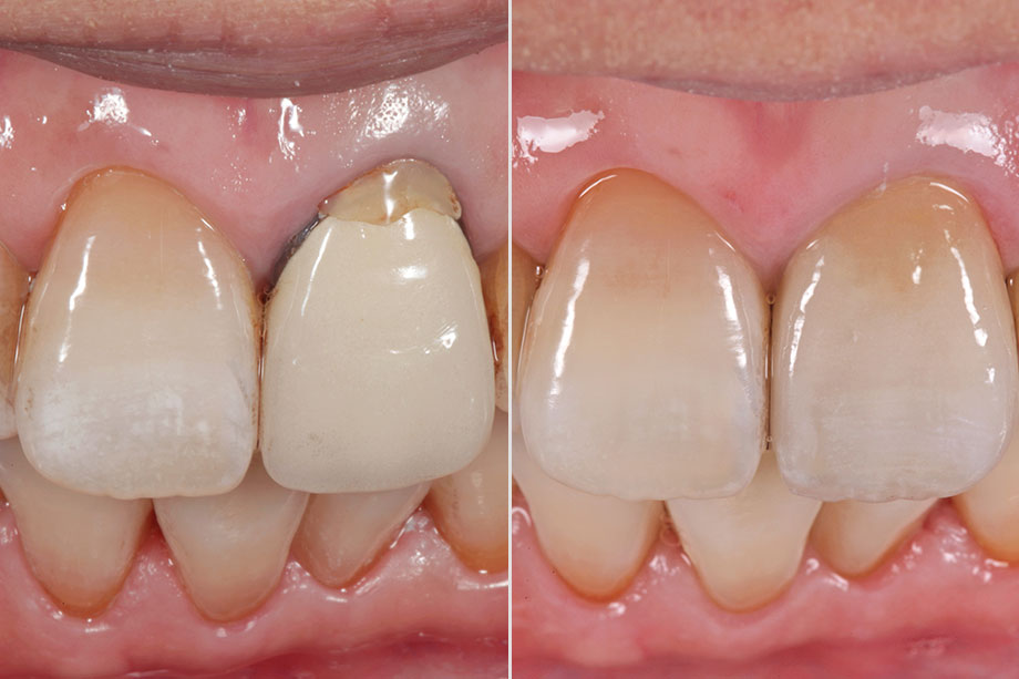 Исходная ситуация: Инициальная клиническая ситуация с несостоятельной металлокерамической коронкой на зубе 21.