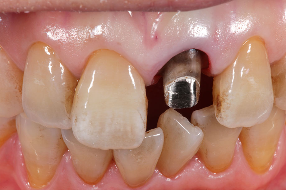 Ill. 2 Le retrait de la couronne révèle une dentine
décolorée et une structure métallique. Ill. 2 Le retrait de la couronne révèle une dentine
décolorée et une structure métallique.