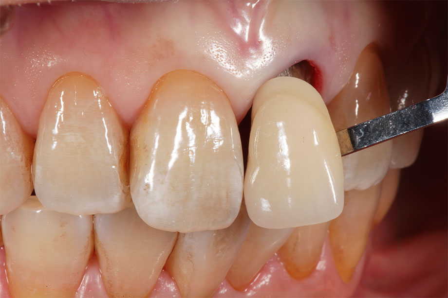 Abb. 3 Die Zahnfarbe wurde mittels VITA Linearguide 3D-MASTER ermittelt.