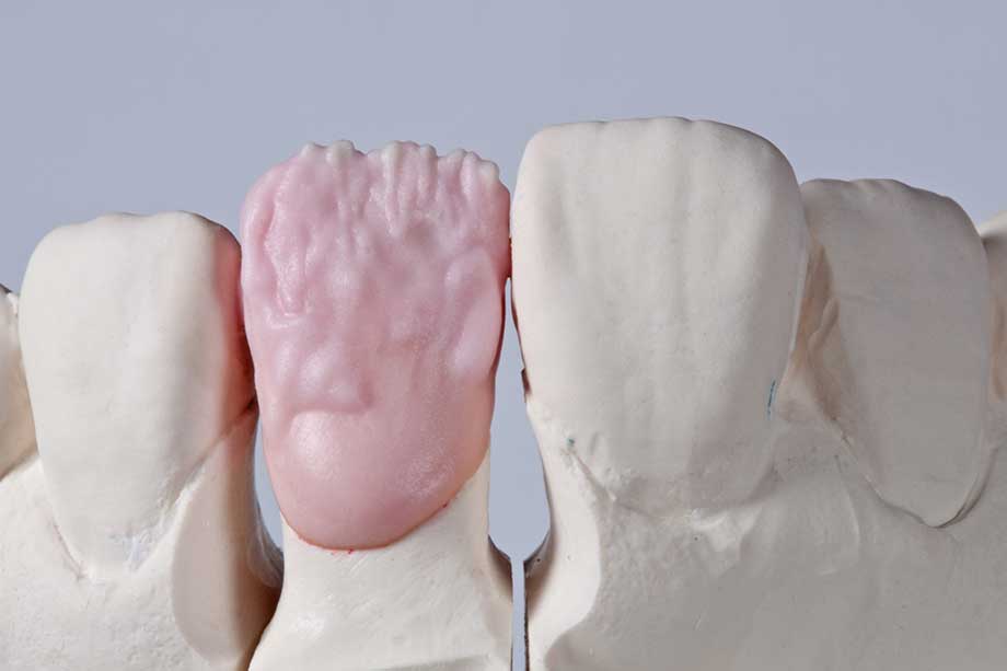 Ill. 7 Le noyau de dentine a été créé et personnalisé Avec VITA VM9 BASE DENTINE 3M2. Ill. 7 Le noyau de dentine a été créé et personnalisé Avec VITA VM9 BASE DENTINE 3M2.