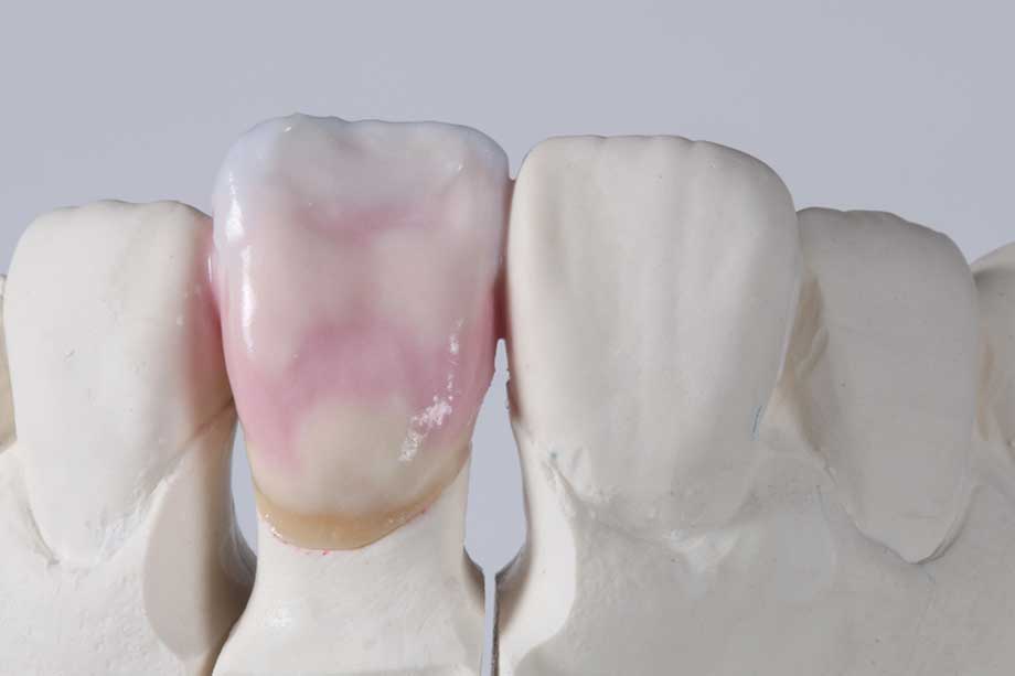 Ill. 9 Stratification de 3M2 avec des effets individuels pour la deuxième cuisson de dentine. Ill. 9 Stratification de 3M2 avec des effets individuels pour la deuxième cuisson de dentine.