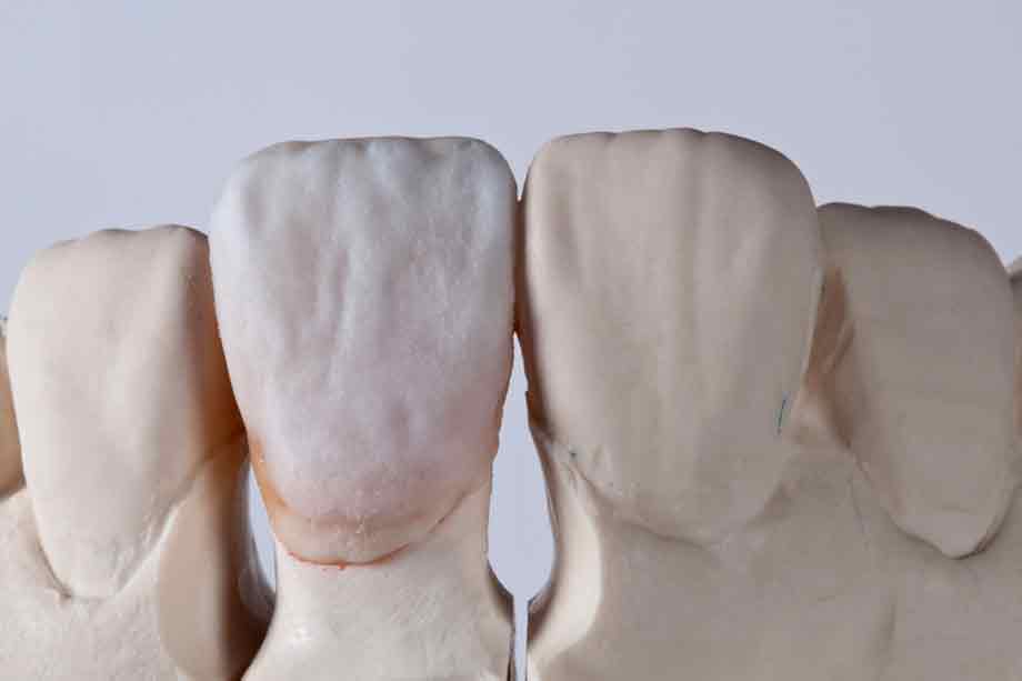 Ill. 11 L'émail a été stratifié avec NEUTRAL, EC1, EE3, EE4, EE5, EE8, EE9 et WINDOW. Ill. 11 L'émail a été stratifié avec NEUTRAL, EC1, EE3, EE4, EE5, EE8, EE9 et WINDOW.