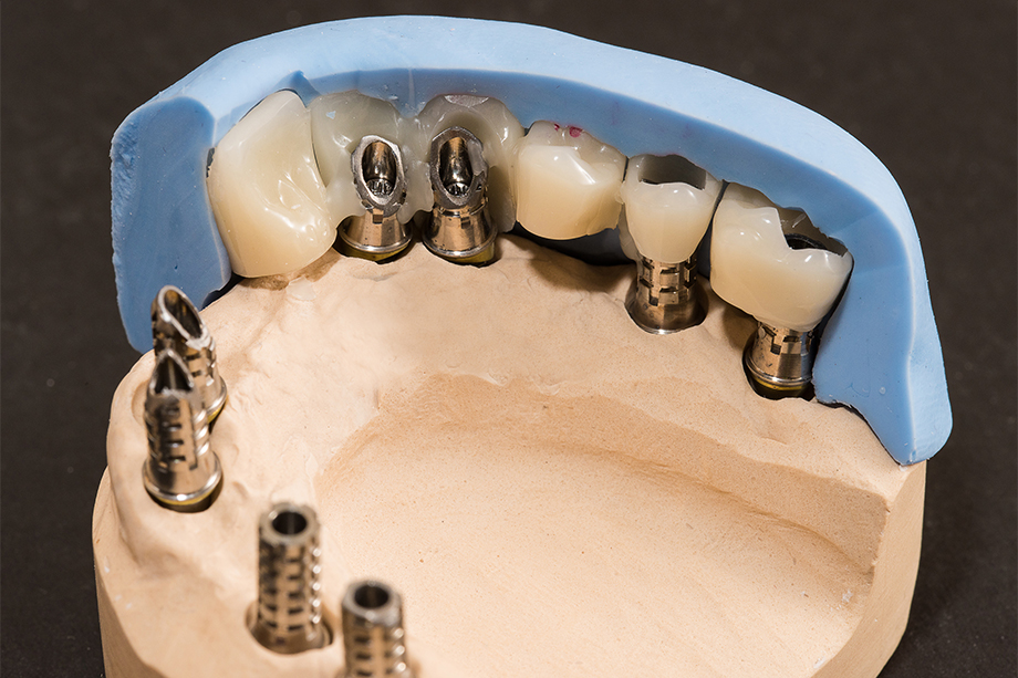 Ill. 4 Un provisoire implanto-porté est préparé à partir de
la matrice en silicone. Ill. 4 Un provisoire implanto-porté est préparé à partir de
la matrice en silicone.