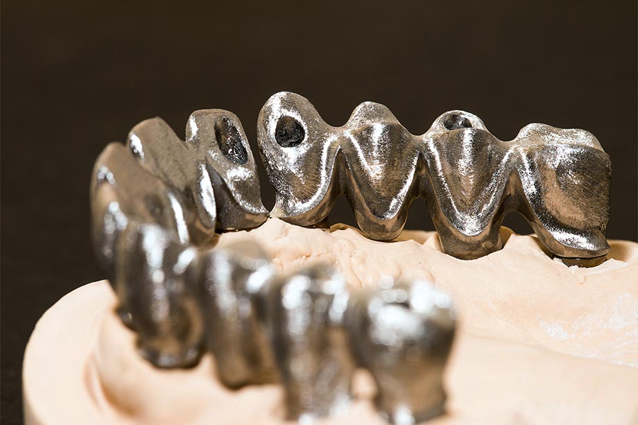 Ill. 6 Les armatures de bridge sont coulées de façon semblable au wax-up. Ill. 6 Les armatures de bridge sont coulées de façon semblable au wax-up.
