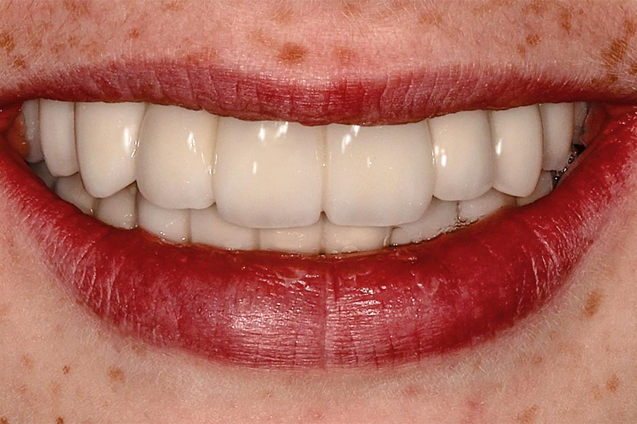 Ill. 11 Joli sourire avec une restauration naturelle et adaptée à l'âge. Ill. 11 Joli sourire avec une restauration naturelle et adaptée à l'âge.