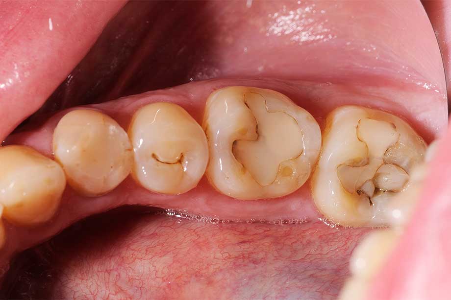 Fig. 1: Situación de partida con obturaciones de composite insuficientes en los dientes 36 y 37.