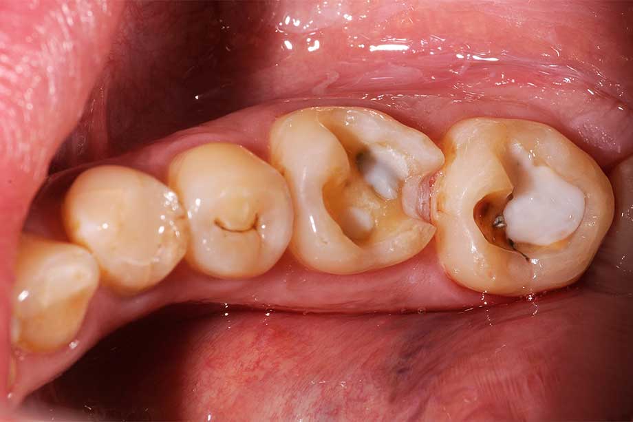 Fig. 2: Defect-oriented preparations after excavation of cavities and adhesive filling.