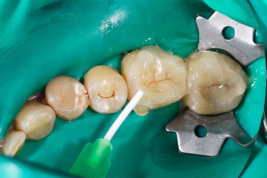 An air block prevents the formation of an oxygen inhibition layer during light curing.