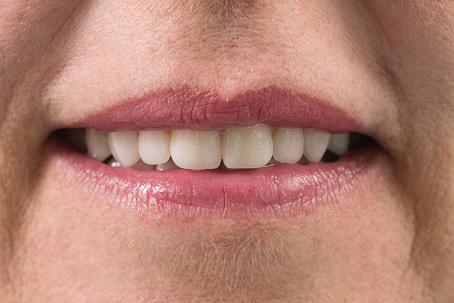 Ill. 9 Étant donné que la dent VITAPAN EXCELL prend pour exemple la dent naturelle