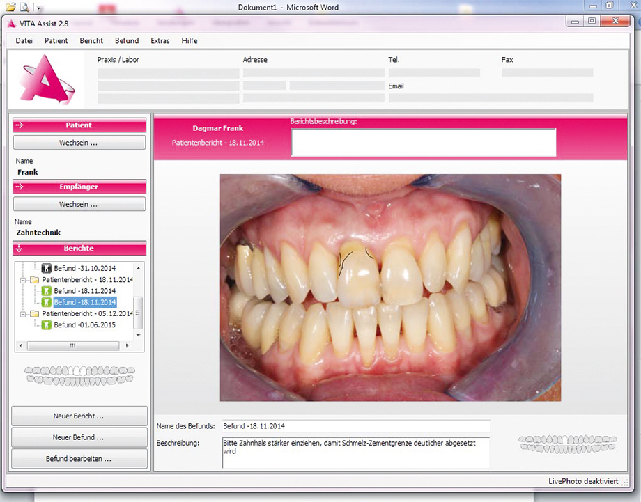 Visualisierung der am Zahnhals zu breiten Krone 11 und Korrekturvorschlag im Beschreibungsfeld