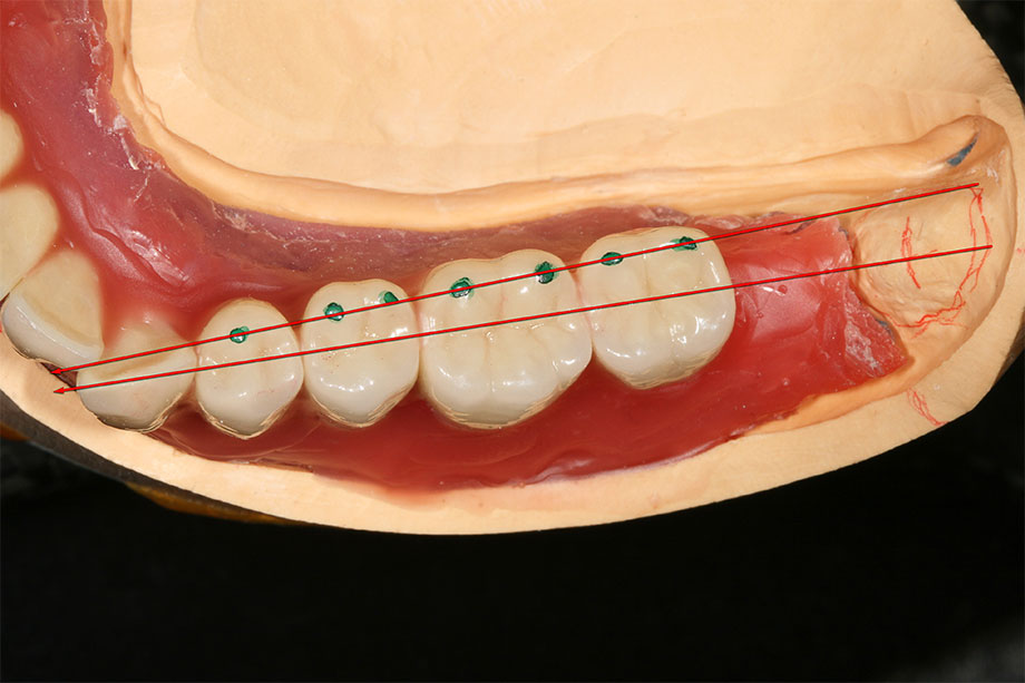 6. Set up on center of the jaw ridge in the lower jaw (green points =lingual margin). 6. Set up on center of the jaw ridge in the lower jaw (green points =lingual margin).