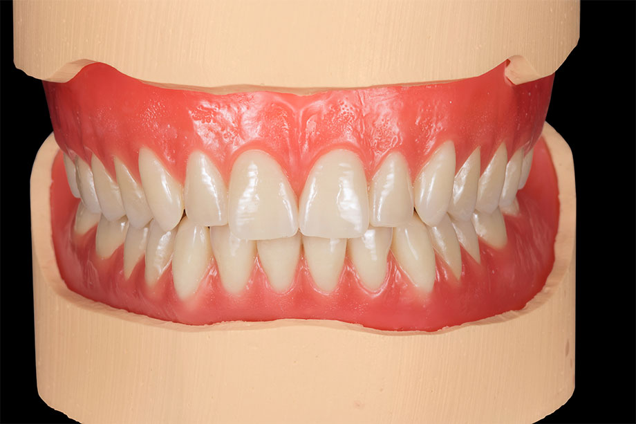 7. The final set up in wax before polymerization. 7. The final set up in wax before polymerization.