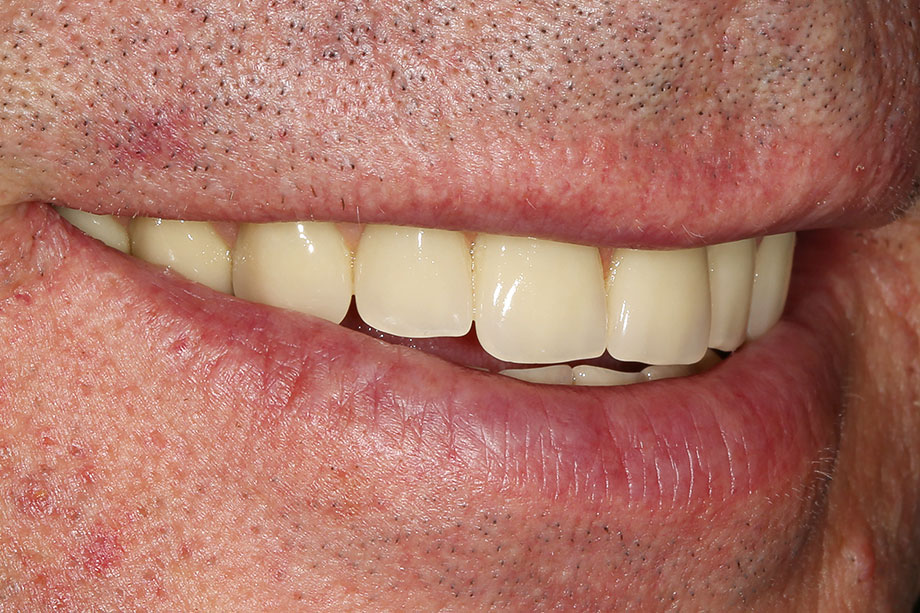 10. Final, integrated restoration in the patient's mouth. 10. Final, integrated restoration in the patient's mouth.