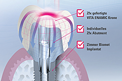 Ein Gesamtkonzept aus Implantat (Zimmer Biomet), Zfx Implantataufbauten und der Hybridkeramik VITA ENAMIC. Ein Gesamtkonzept aus Implantat (Zimmer Biomet), Zfx Implantataufbauten und der Hybridkeramik VITA ENAMIC.