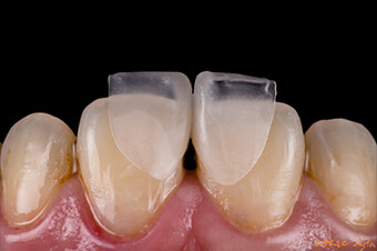 CEREC Digest: Clinical case by Hsuan Chen